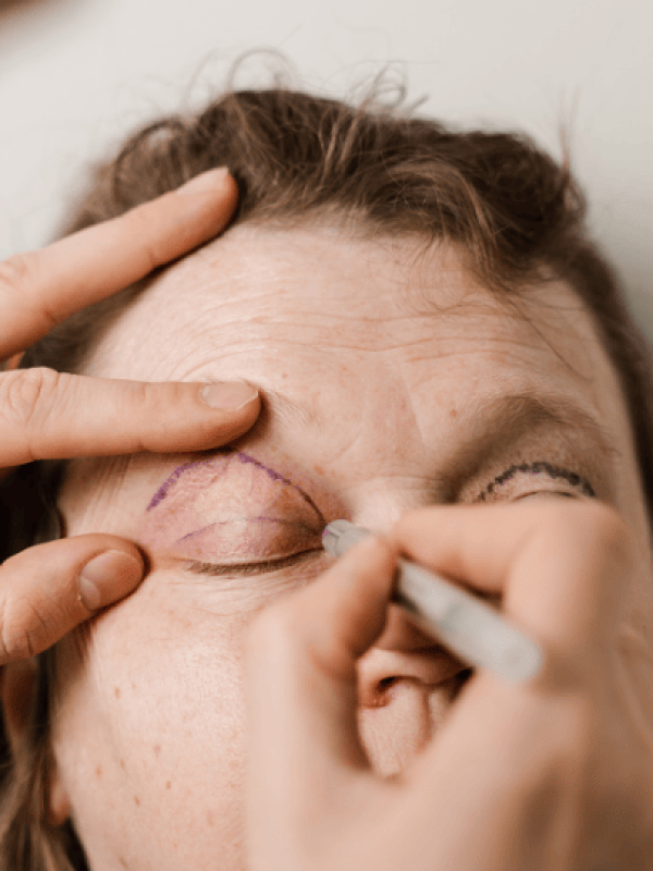 Imagen cita de valoración blefaroplastia